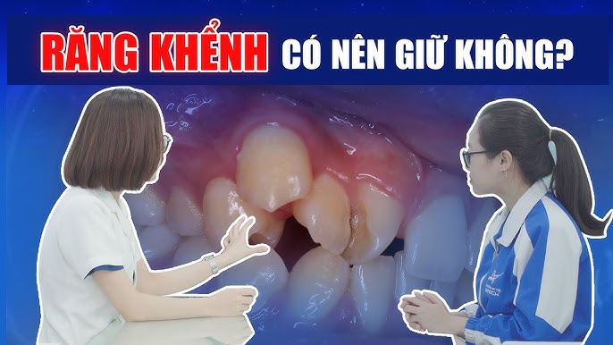 Răng khểnh: Sự thật đằng sau nụ cười duyên và những rủi ro tiềm ẩn