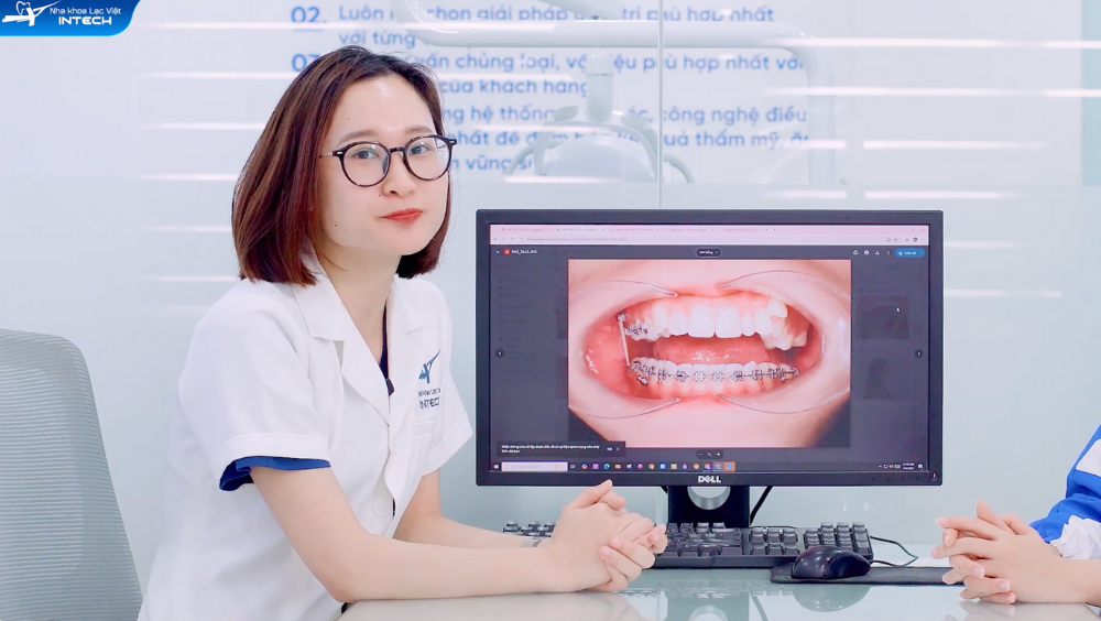 Răng khểnh có niềng răng được không?