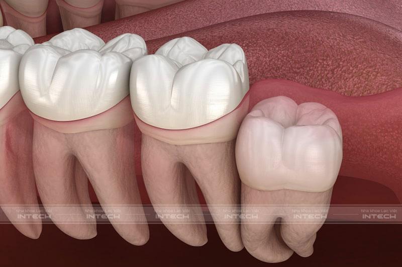 Răng khôn không đóng vai trò quan trọng trong việc nhai, nghiền thức ăn