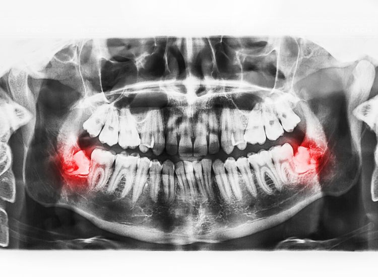 Răng khôn xuất hiện trong cung hàm