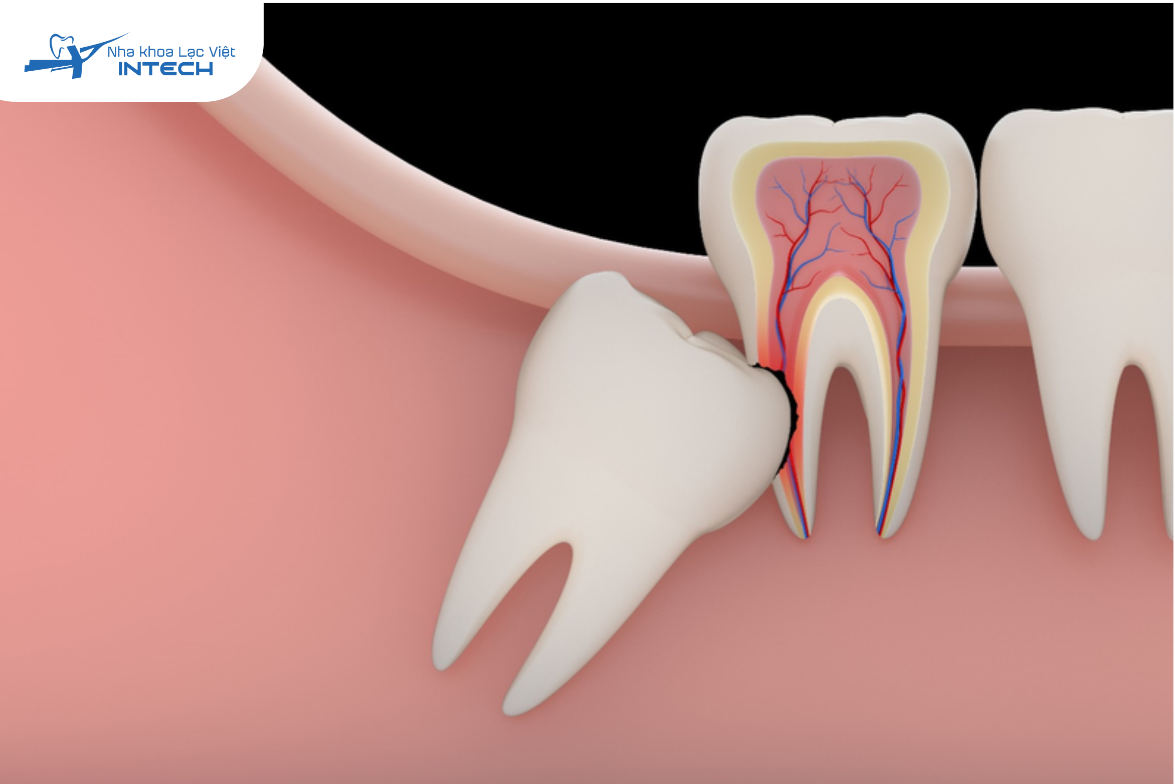Răng khôn hay mọc lệch vì không gian còn lại trên cung hàm thường không đủ để răng khôn mọc lên một cách bình thường