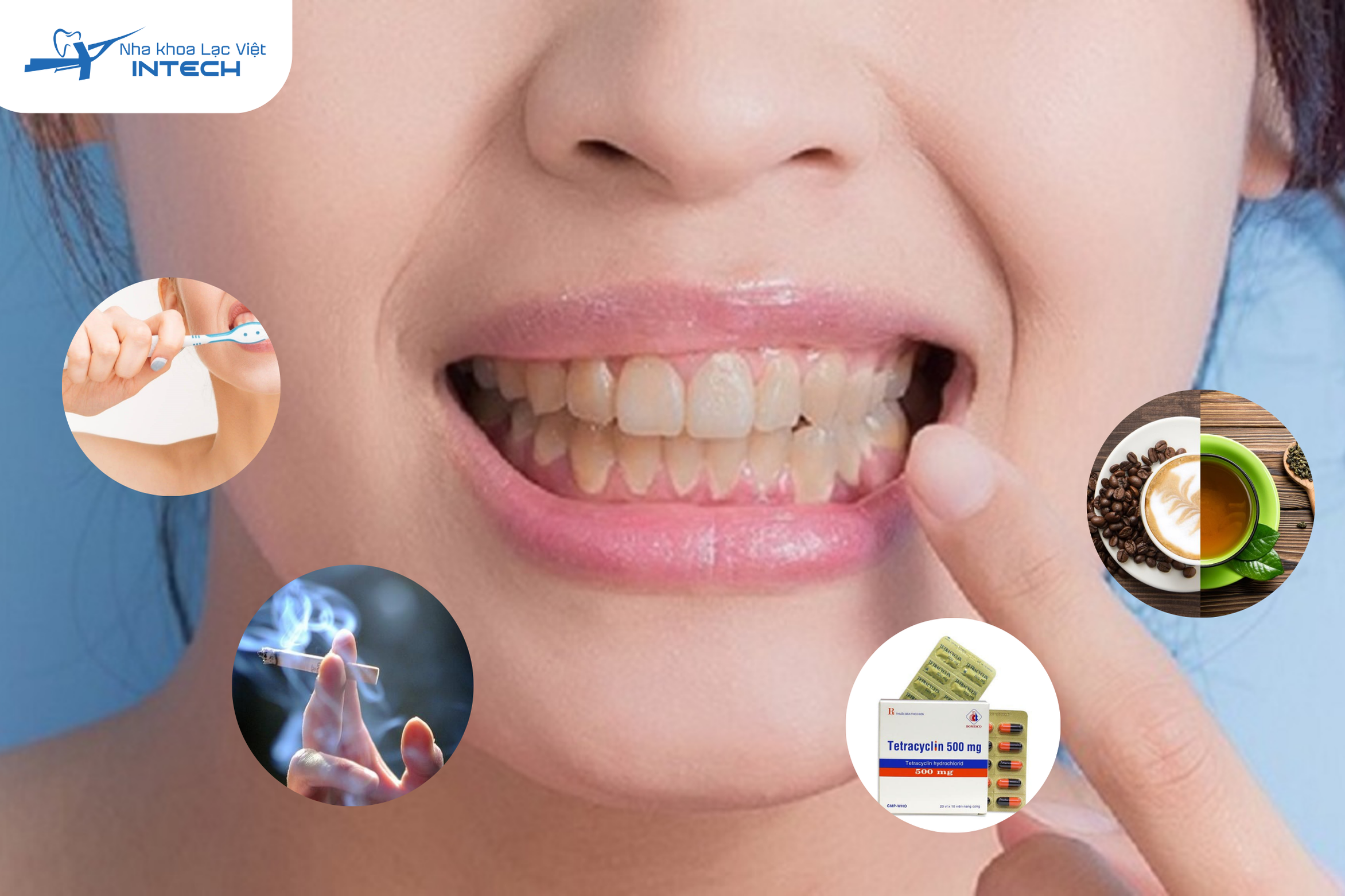 Có rất nhiều "thủ phạm" có thể khiến nụ cười của cô chú anh chị mất đi vẻ trắng sáng