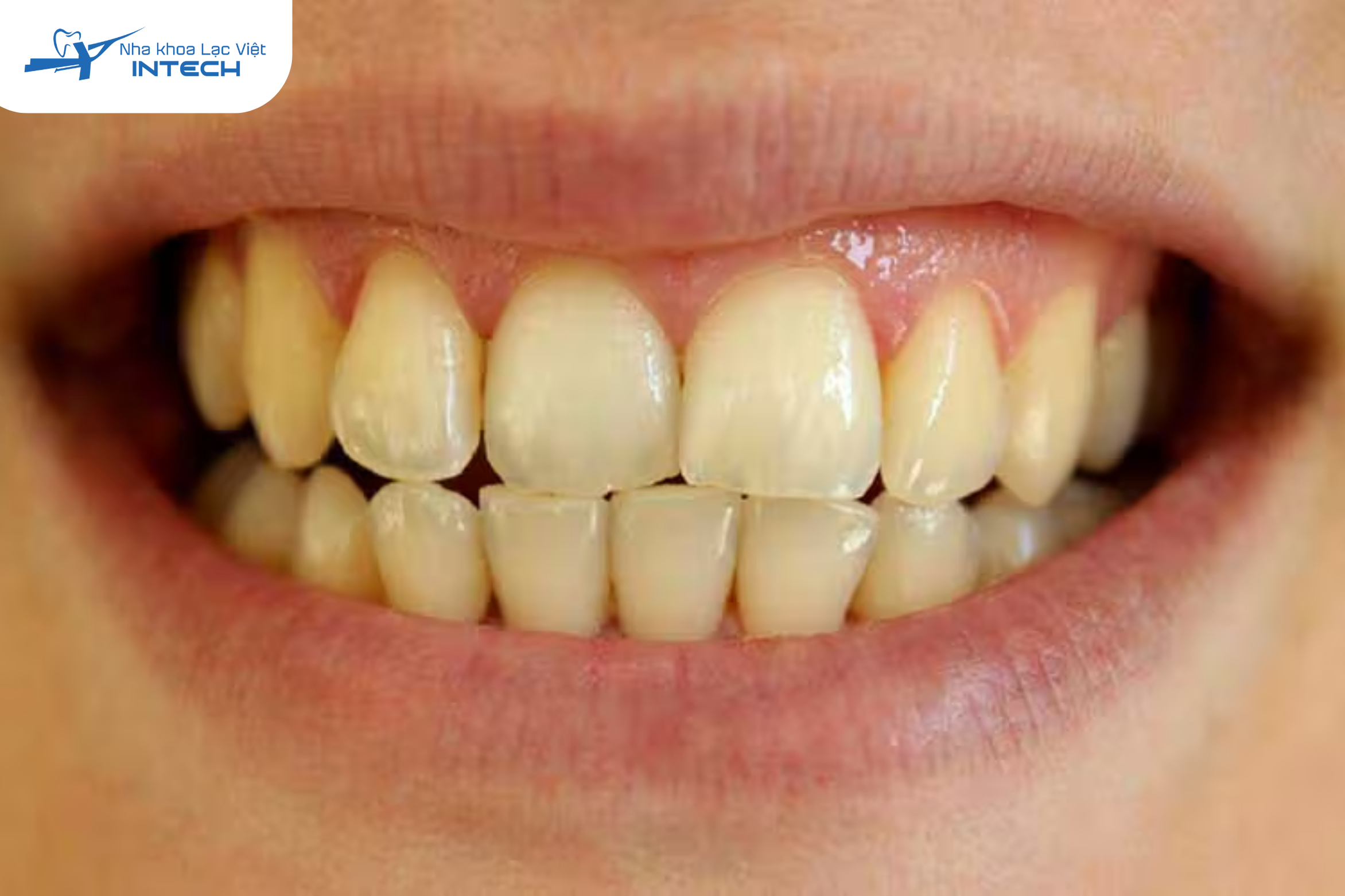 Răng ố vàng mất đi độ trong và độ sáng bóng vốn có, tạo cảm giác cũ và kém vệ sinh