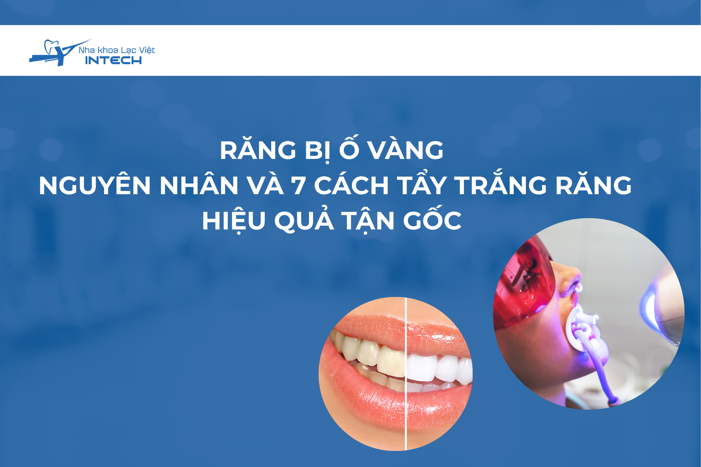 Răng bị ố vàng: Nguyên nhân và 7 cách tẩy trắng răng hiệu quả tận gốc