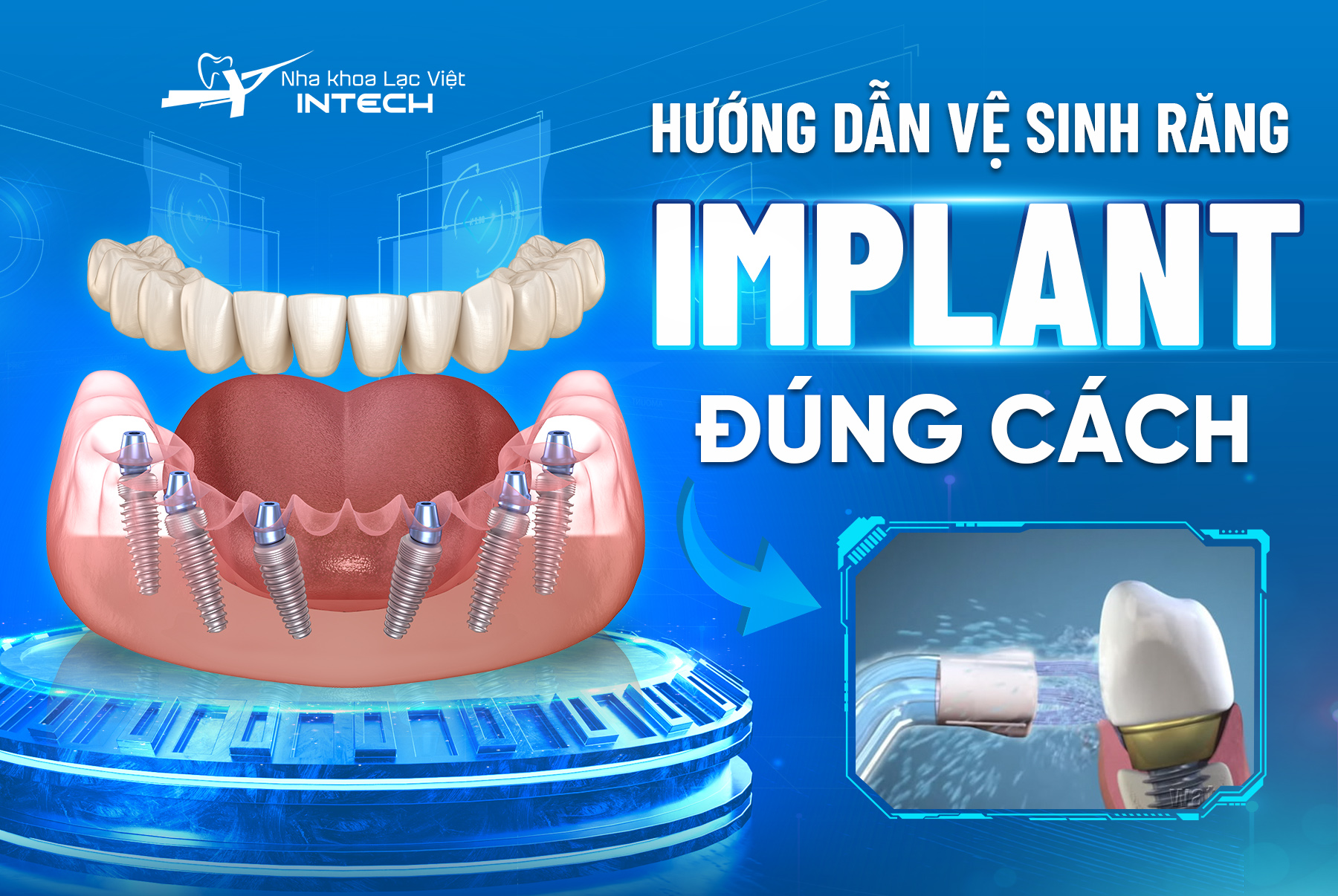 Răng sau cắm Implant cần được chăm sóc đúng cách để duy trì độ bền vững