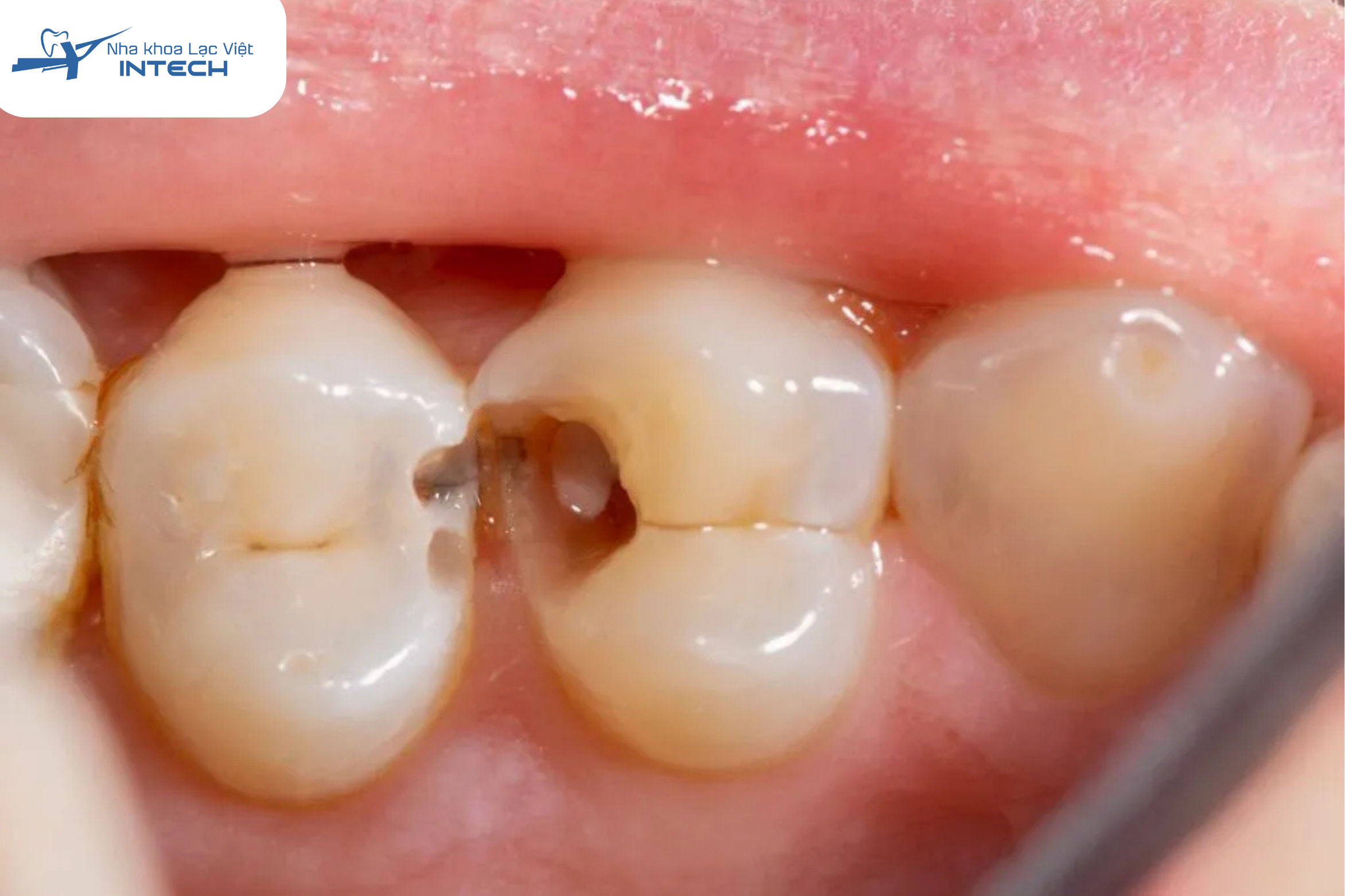 Răng sâu nhẹ, lỗ nhỏ là trường hợp chưa cần thiết phải bọc sứ