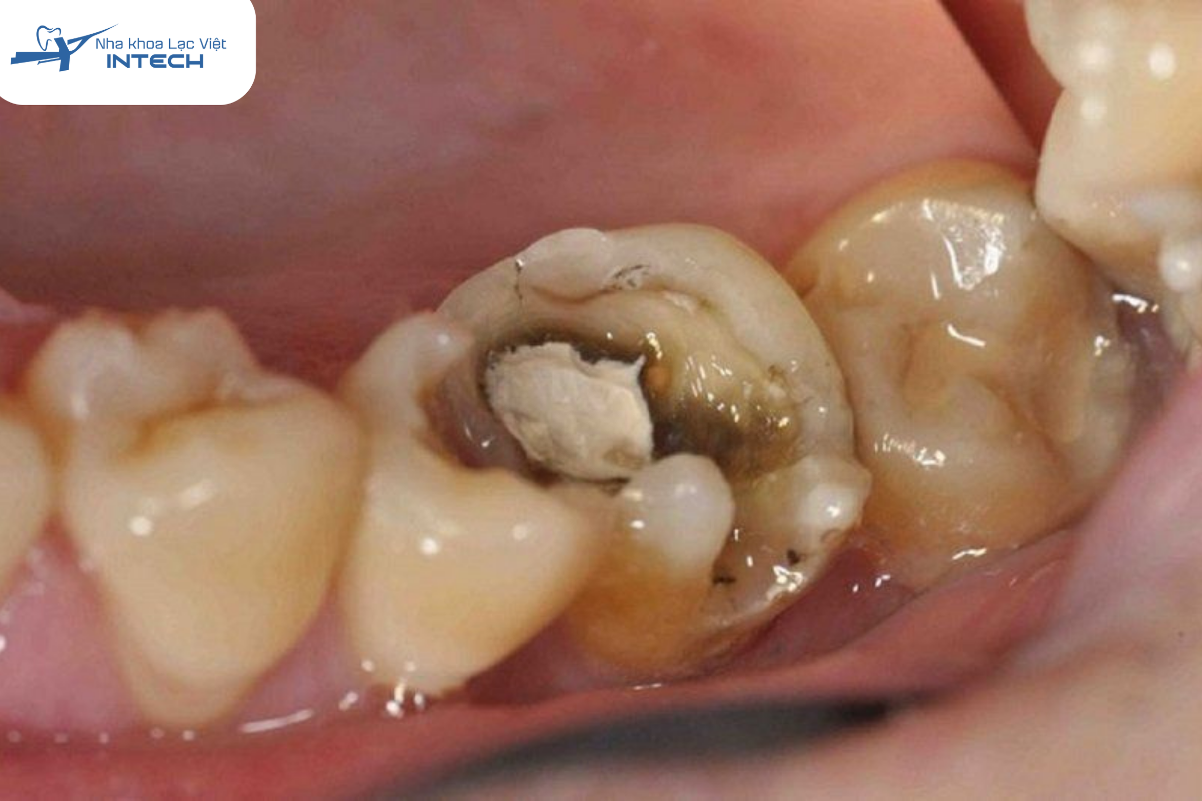 Răng sâu vỡ lớn là trường hợp nên bọc sứ để bảo vệ răng thật