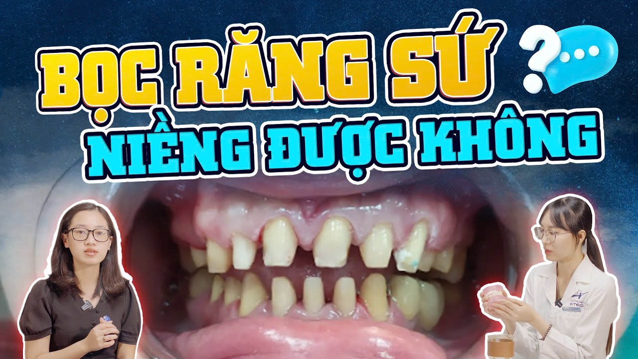 Bọc Răng Sứ Có Niềng Được Không: 3 Lưu Ý Để Tránh Mất Tiền Oan Khi Niềng Răng Bọc Sứ