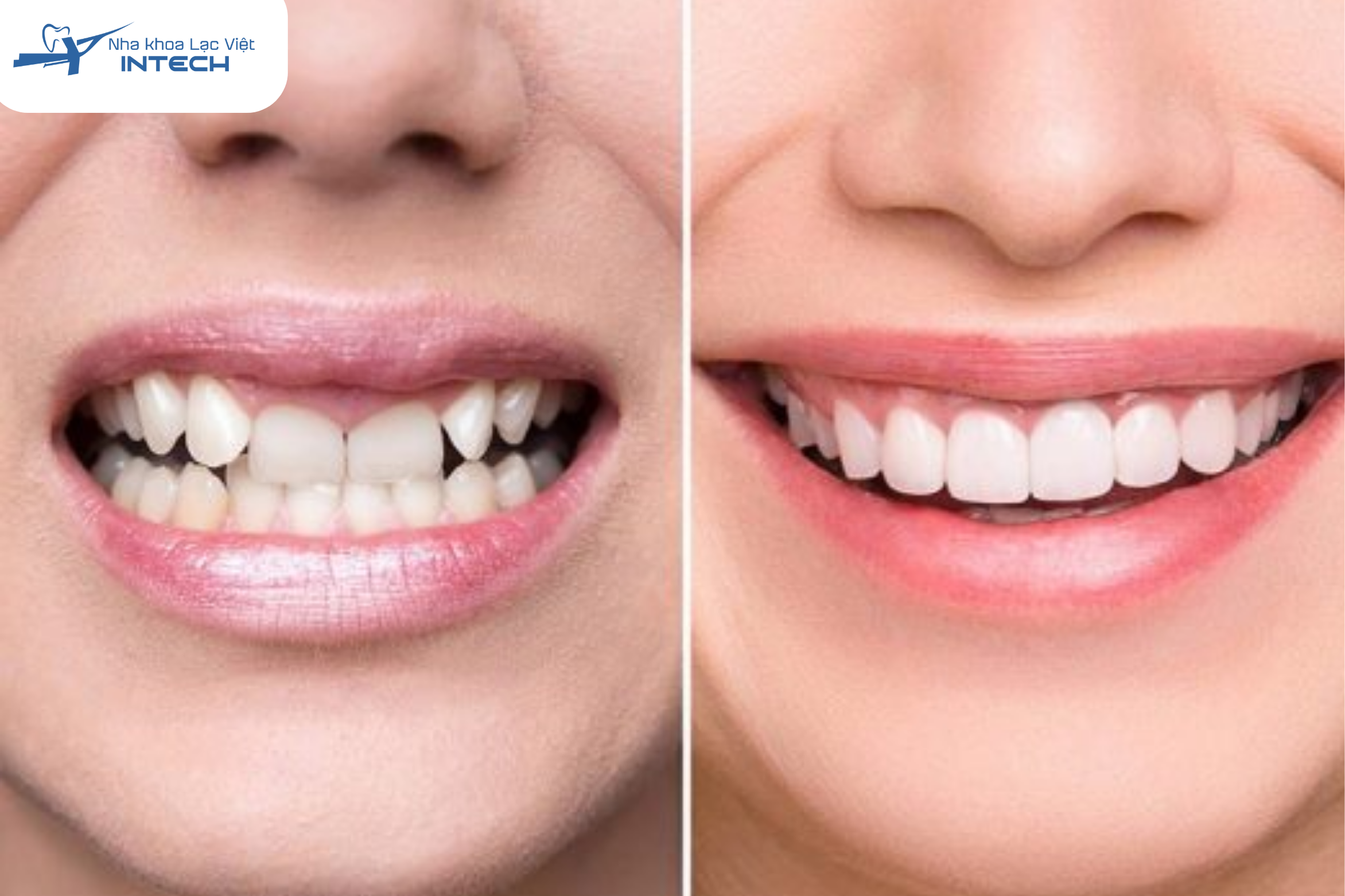 Bọc răng sứ thỏ khắc phục được nhiều khuyết điểm cùng lúc, độ bền cao, màu sắc và hình dáng được cải thiện triệt để