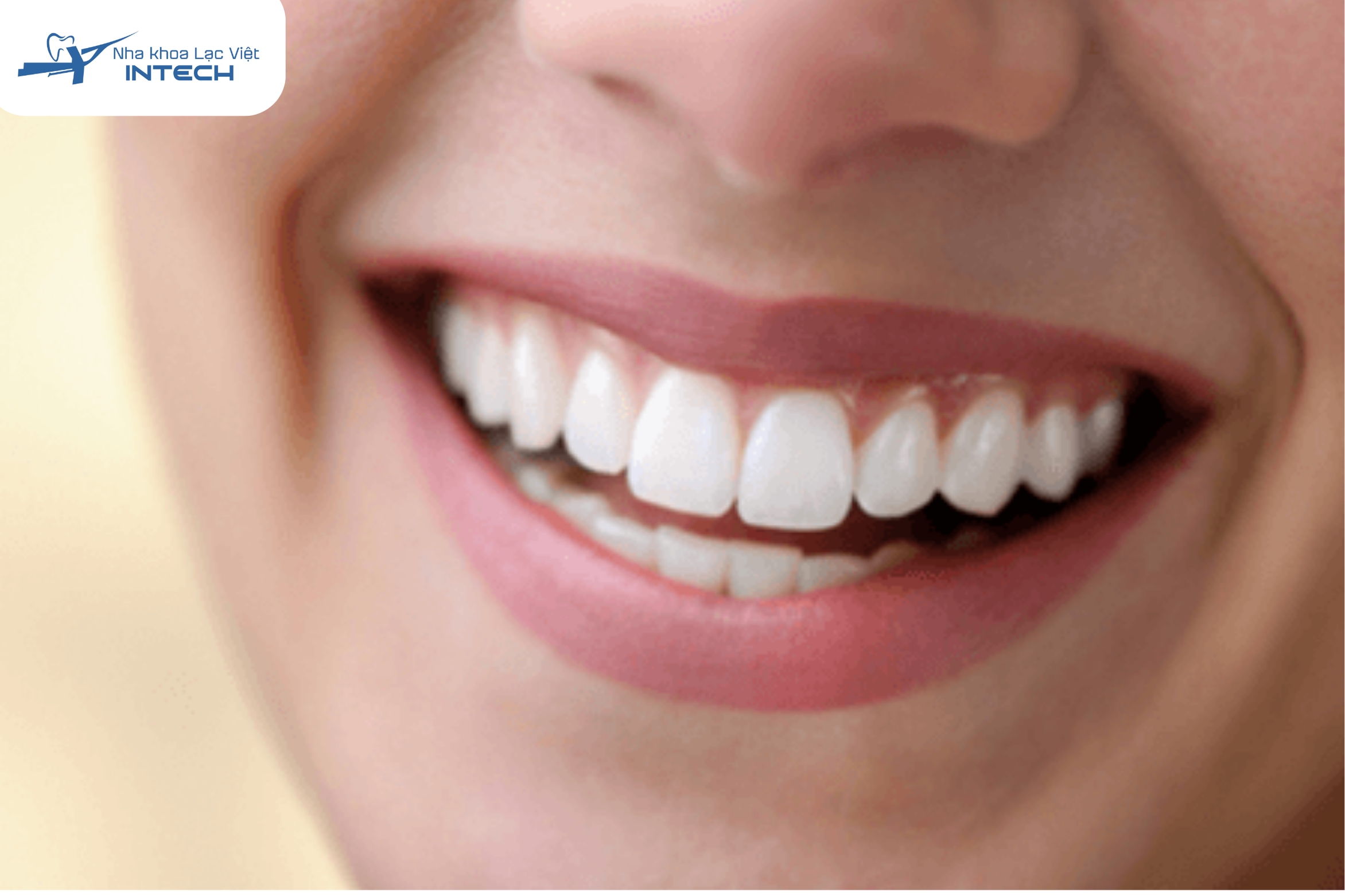 Răng sứ thỏ tạo nên điểm nhấn cho người sở hữu