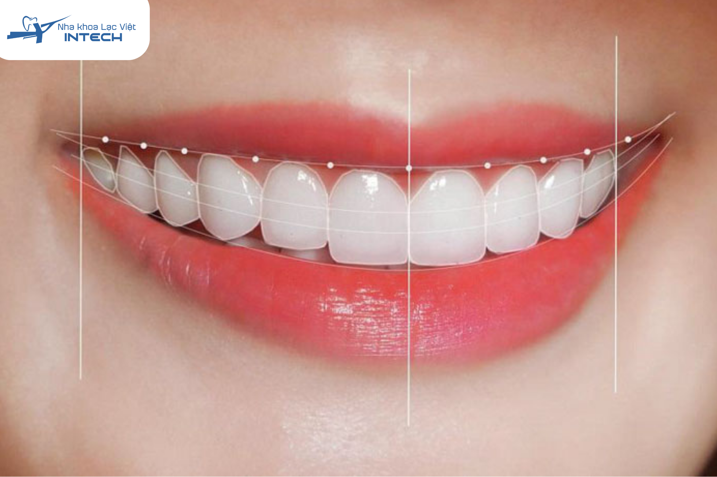 Răng sứ thỏ đẹp khi có tỉ lệ cân đối với khuôn mặt