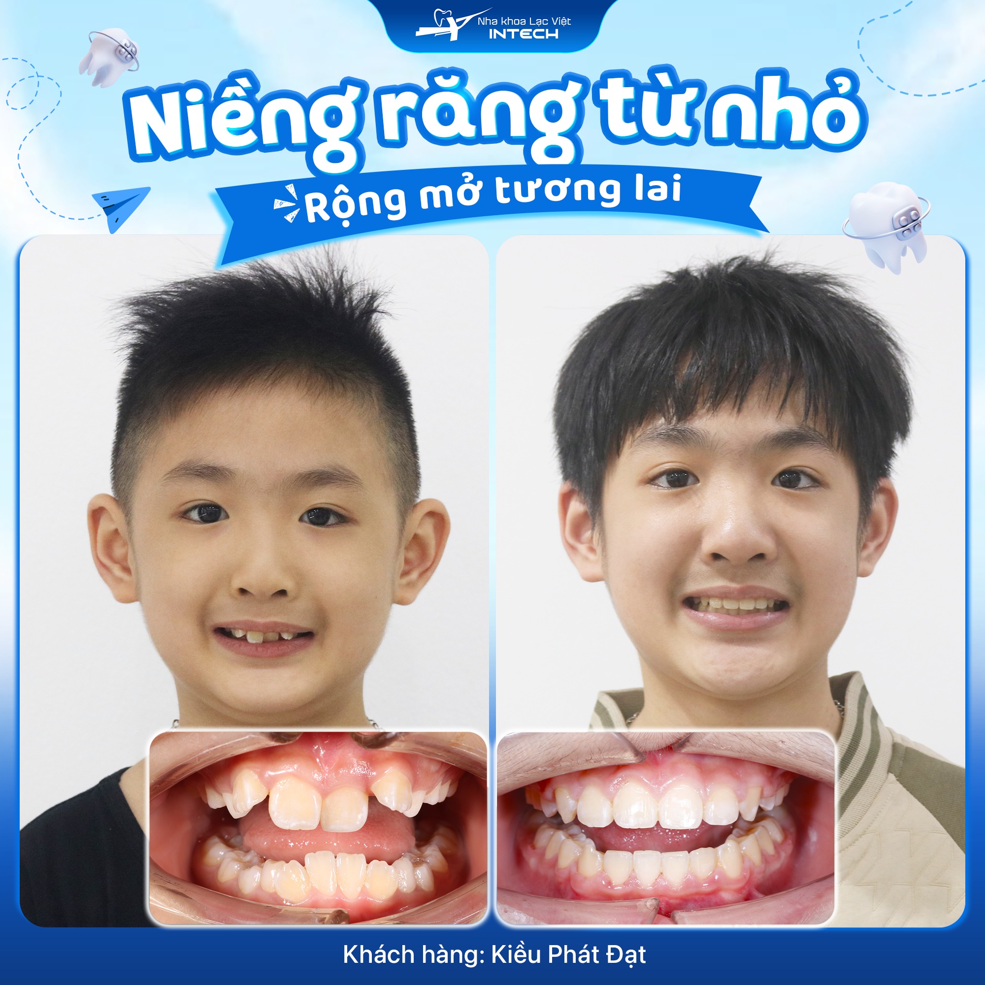 Chỉnh nha trẻ em chính xác, an toàn với công nghệ X-Matrix hiện đại.