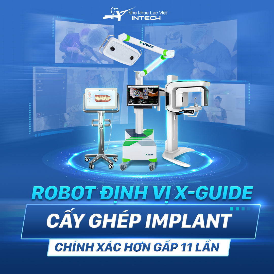 Trồng răng Implant bằng Robot định vị X-Guide