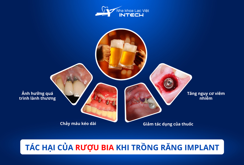 Rượu bia có thể gây ra nhiều biến chứng phức tạp, dẫn đến viêm nhiễm và đào thải trụ Implant