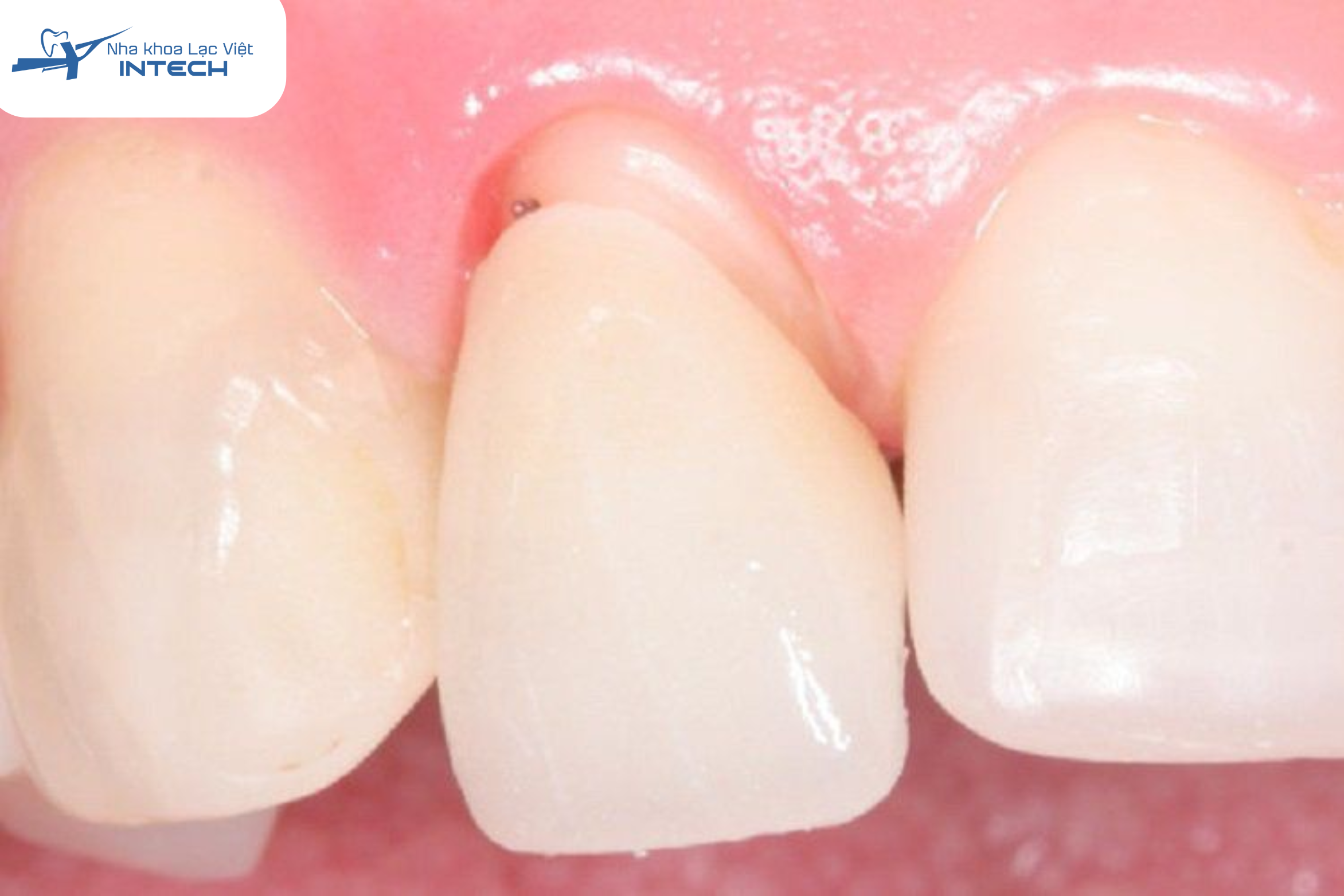 Hở viền nướu gây giắt thức ăn, ảnh hưởng nghiêm trọng đến thẩm mỹ, đặc biệt là ở vùng răng cửa