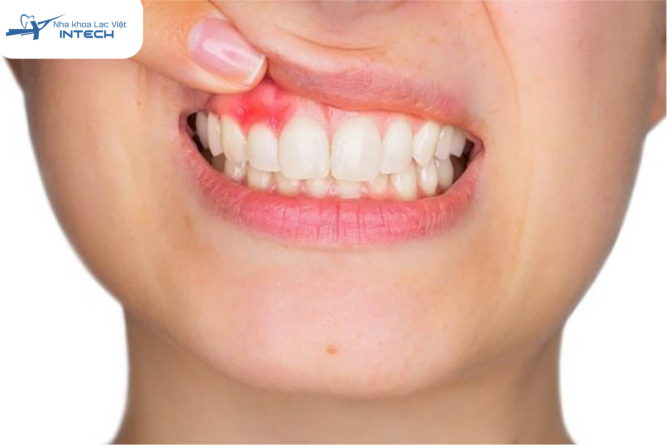 Việc điều trị các bệnh lý răng miệng trước khi bọc răng sứ vô cùng quan trọng