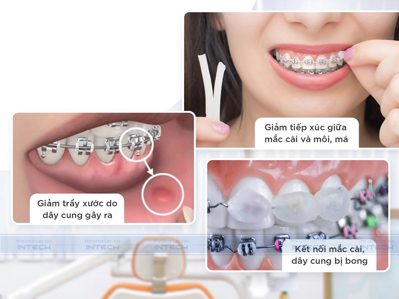 Tác dụng của sáp niềng răng