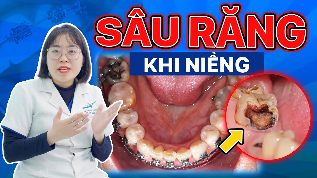 Sâu răng khi niềng - Đừng để răng hỏng vì chủ quan, bác sĩ chia 3 cách chữa an toàn