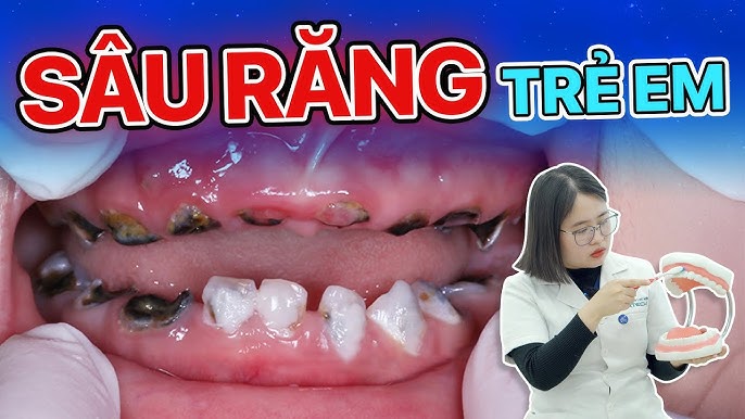 Sâu răng ở trẻ em: Nguyên nhân, dấu hiệu và cách chữa trị từ chuyên gia