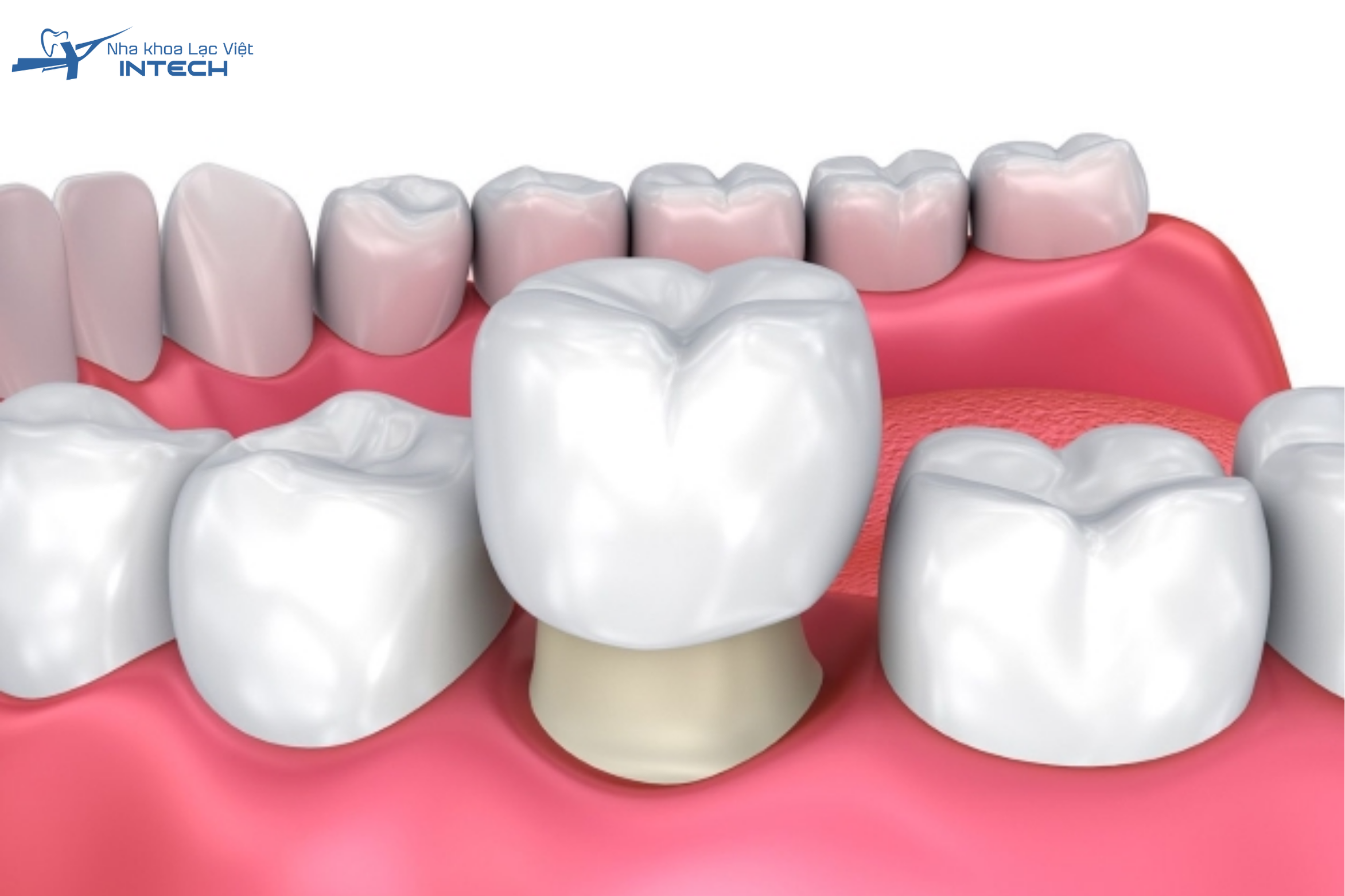 Bọc răng sứ có mão sứ được chế tác theo đúng hình dáng và kích thước răng mong muốn sẽ được chụp cố định lên cùi răng đã mài
