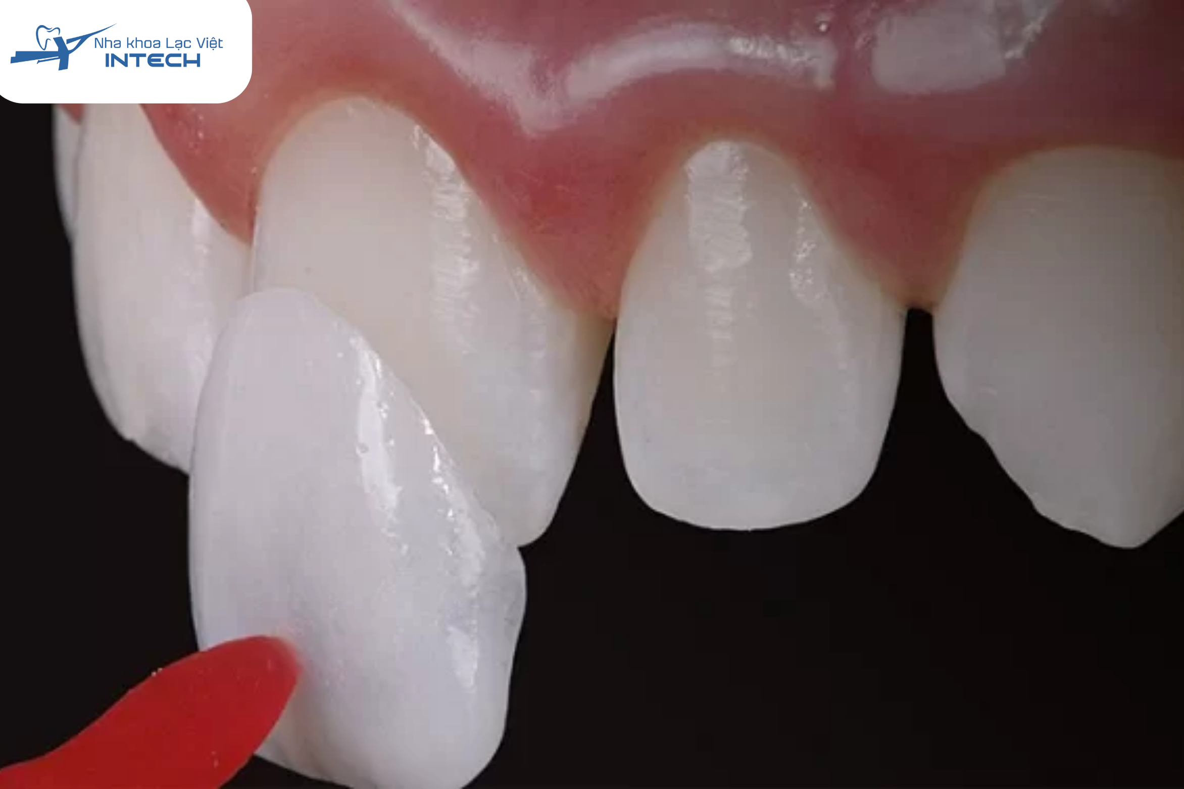 Dán sứ veneer là một kỹ thuật nha khoa thẩm mỹ tiên tiến, tập trung vào việc bảo tồn tối đa mô răng thật