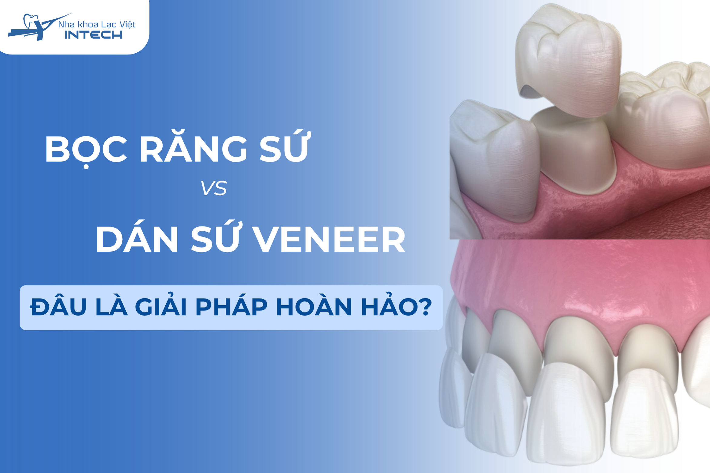 Bọc răng sứ và dán sứ veneer: Đâu là giải pháp hoàn hảo cho nụ cười?