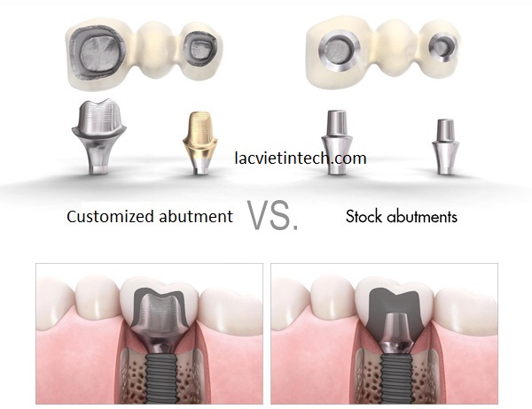 : So sánh trụ phục hình cá nhân hóa và Abutment Stock