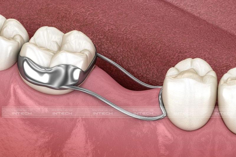 Sử dụng hàm giữ khoảng khi bị mất răng cho đến khi đủ tuổi cấy Implant