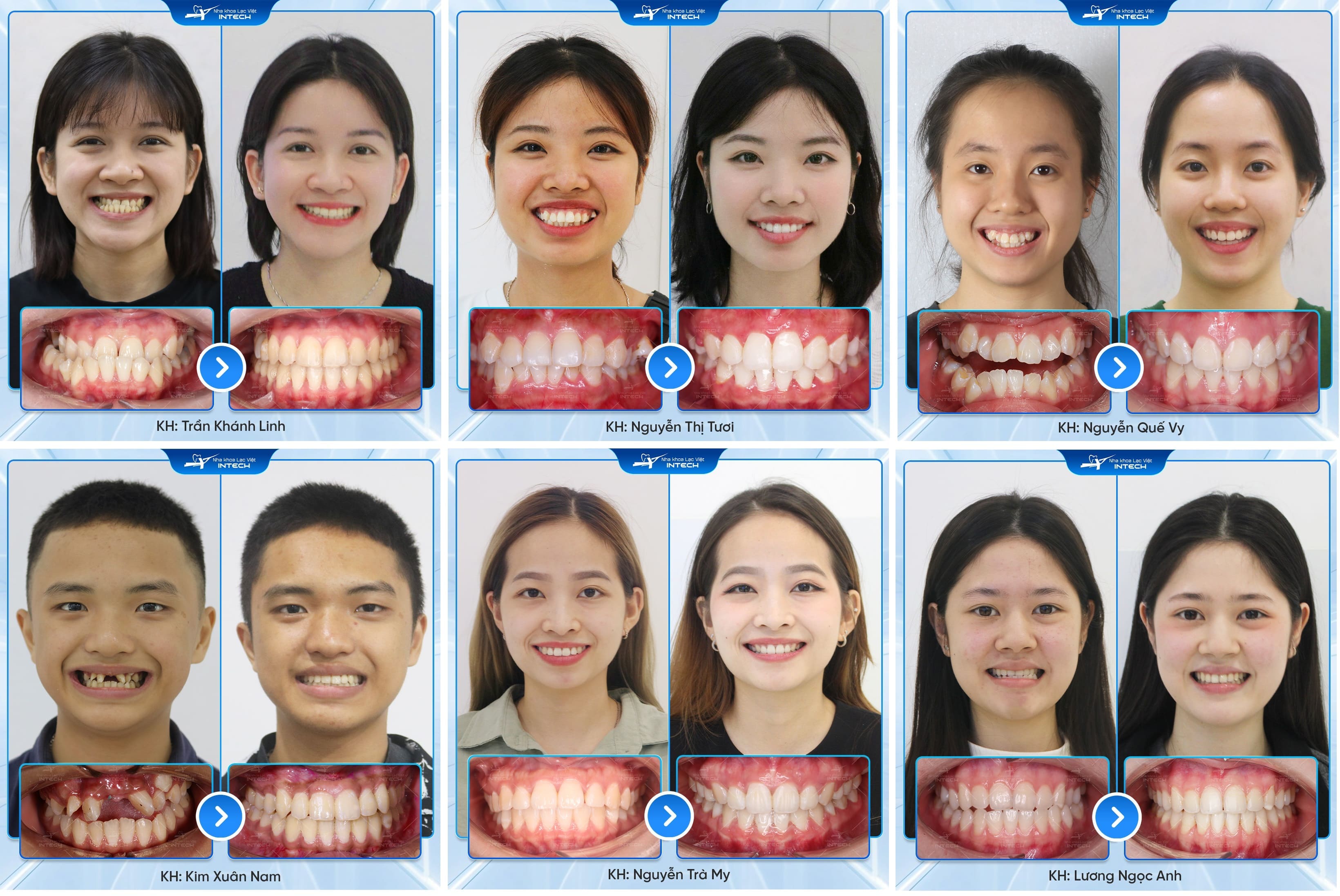 thay đổi của khách hàng sau khi niềng răng