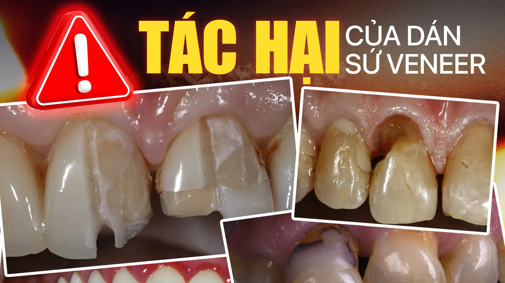 5 tác hại của dán sứ veneer bác sĩ không bao giờ tiết lộ! 