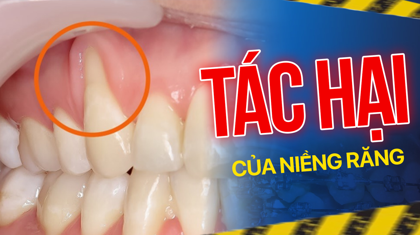 Cảnh giác với 13 tác hại của niềng răng và sự thật động trời! 