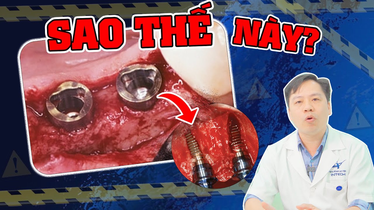 3 Nhóm Tác Hại Của Trồng Răng Implant| Đặc Biệt Nhóm Tác Hại Thứ 2 Không Thể Coi Thường!