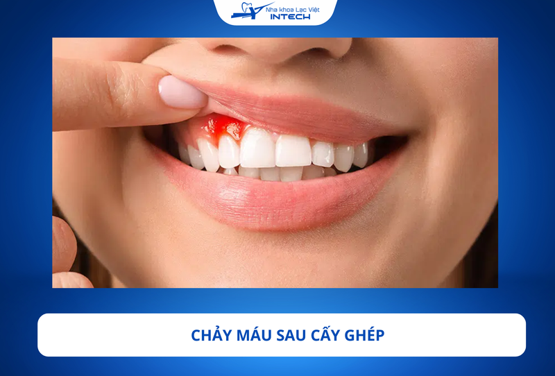 Cô chú/anh chị có thể gặp tình trạng chảy máu nhẹ sau cấy ghép, khiến nước bọt có màu hồng