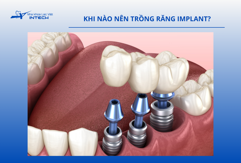 Cô chú/anh chị nên thực hiện khi mất răng do sâu răng, chấn thương hoặc bệnh lý nha chu