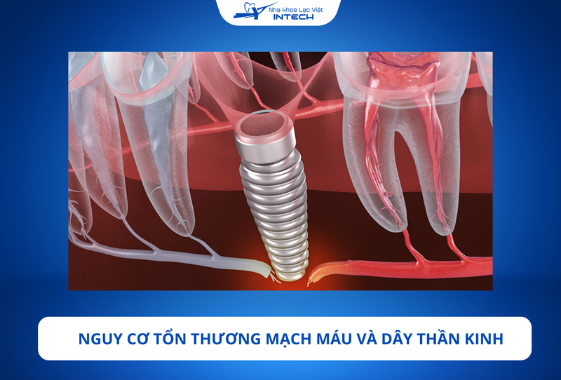 Nếu trụ Implant đặt quá sâu, có thể xảy ra một trong những biến chứng nghiêm trọng như tổn thương dây thần kinh