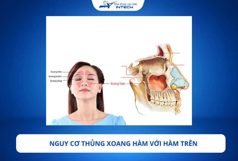 Thủng xoang hàm là một biến chứng nghiêm trọng có thể xảy ra khi cấy ghép Implant vùng răng hàm trên