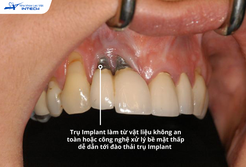 Cảnh báo 4 tác hại của việc trồng răng Implant nếu không tìm hiểu kỹ