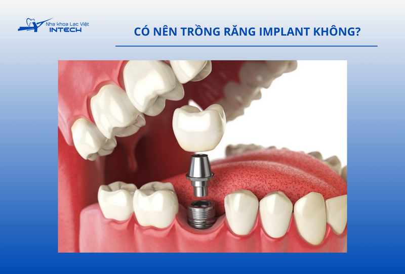 Trồng răng Implant là phương pháp phục hình răng tiên tiến nhất hiện nay, giúp thay thế răng đã mất một cách toàn diện