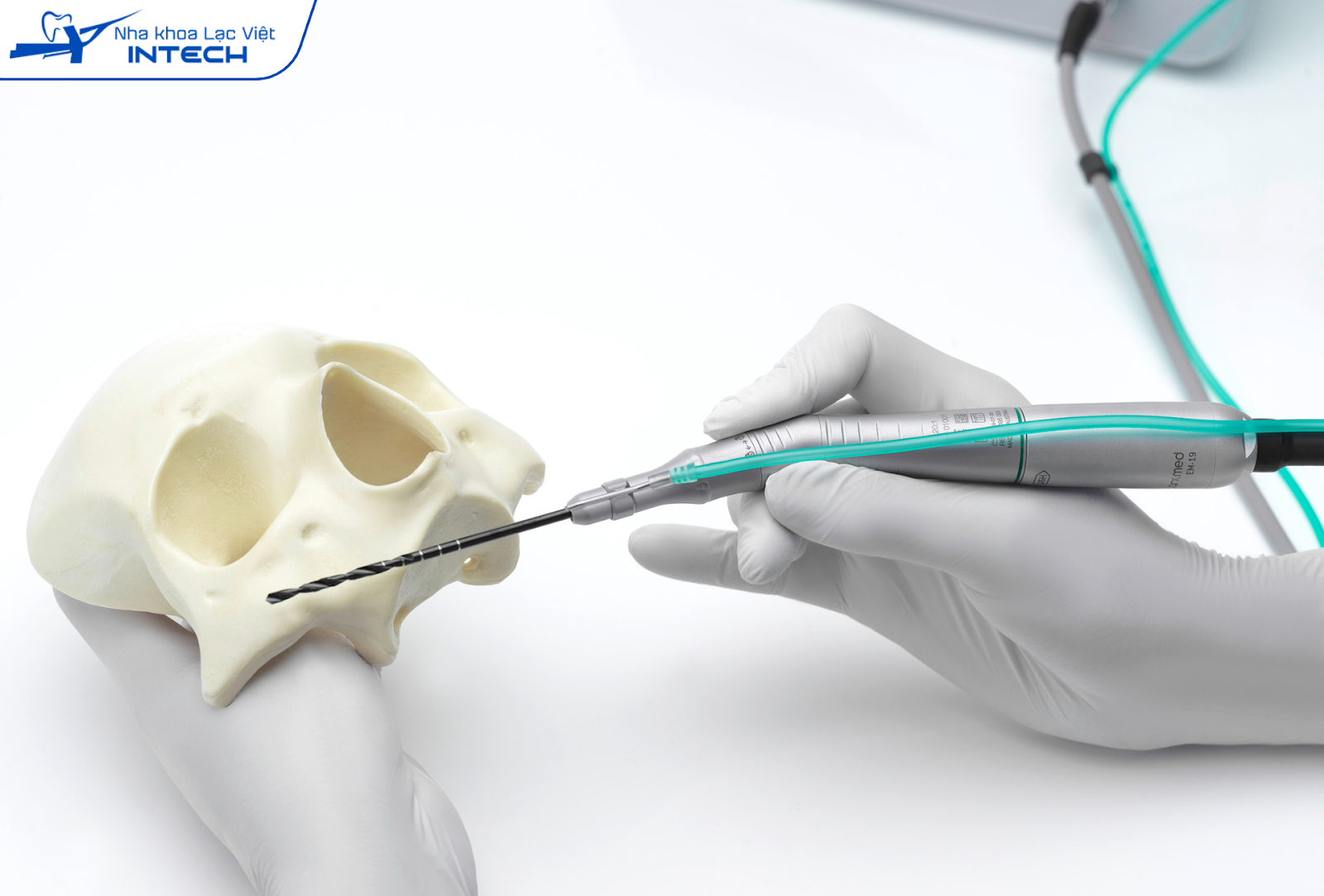 Tay cắm Implant hỗ trợ đặt trụ Implant chính xác, tăng tốc độ cấy ghép
