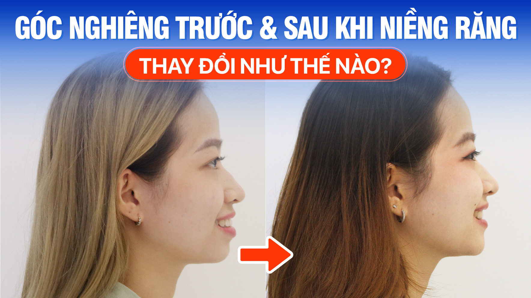 [Ảnh] Góc nghiêng trước và sau khi niềng răng thay đổi như thế nào? 