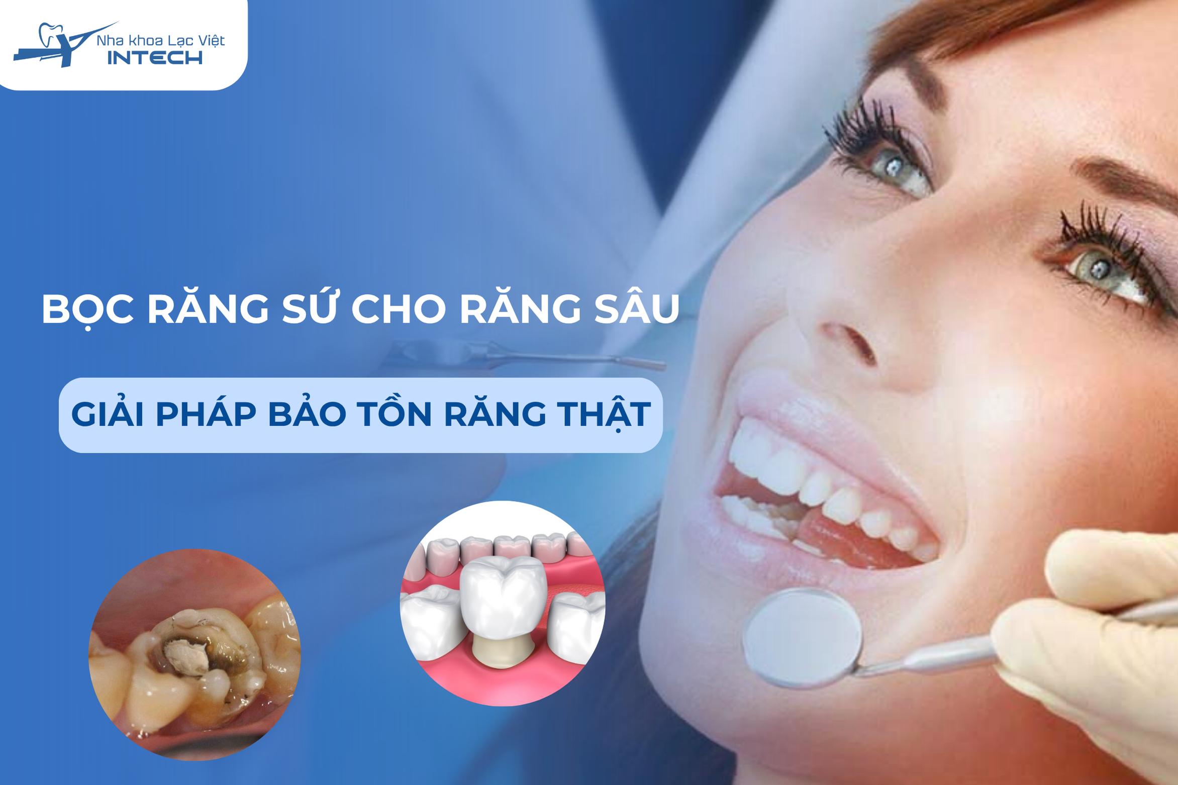 Bọc răng sứ cho răng sâu: Giải pháp bảo tồn răng thật không cần nhổ
