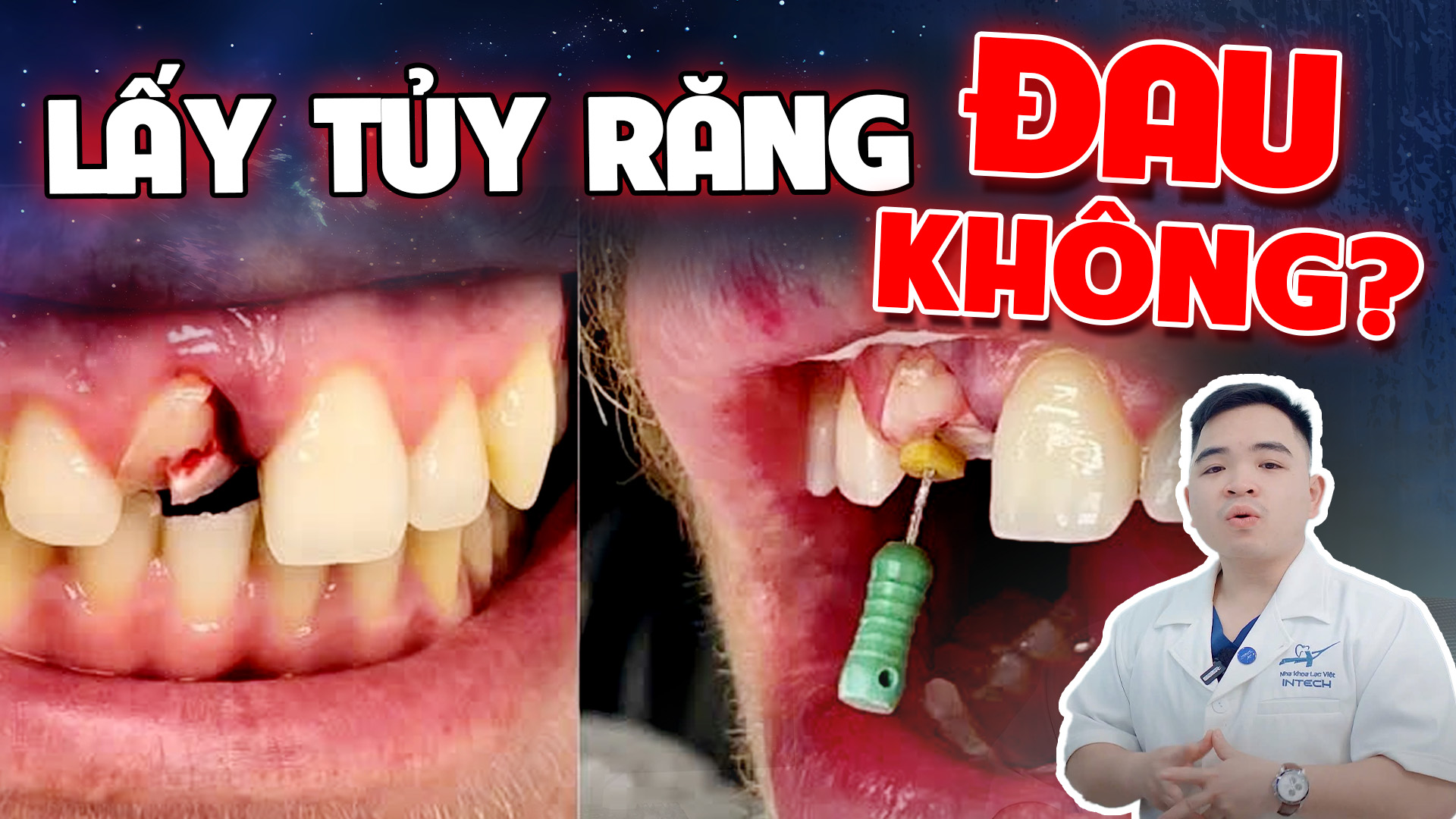 Lấy tủy răng có đau không? Khi nào cần điều trị tủy để bảo tồn răng thật?