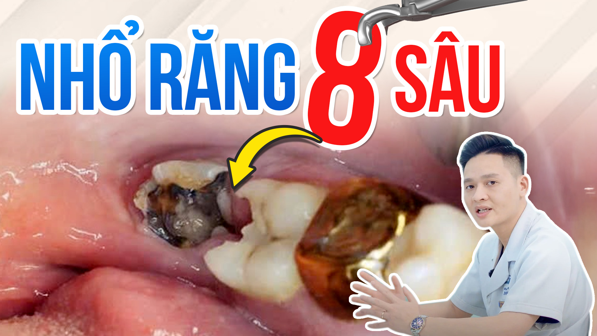 Răng khôn bị sâu: Nên nhổ bỏ hay giữ lại? Khi nào cần nhổ?