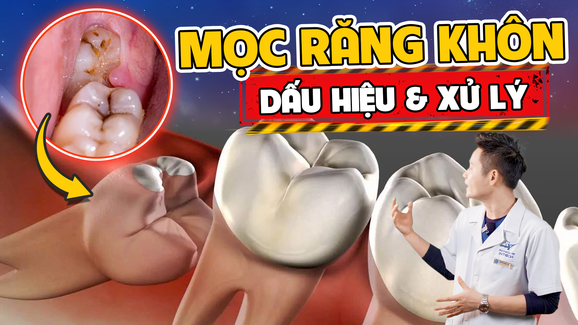 Khi nào cần nhổ răng khôn? Đừng bỏ qua những dấu hiệu nguy hiểm