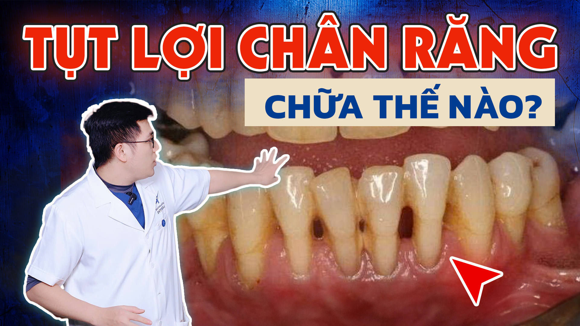 Tụt lợi: Nguyên nhân, hậu quả Và cách điều trị hiệu quả 