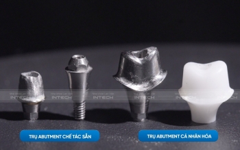 Ưu điểm vượt trội của công nghệ phục hình răng sứ trên implant DCT