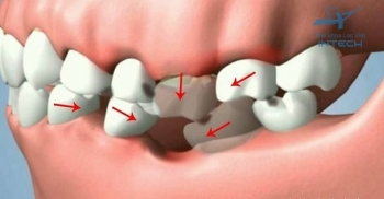 Bị mất 1 răng hàm có sao không?