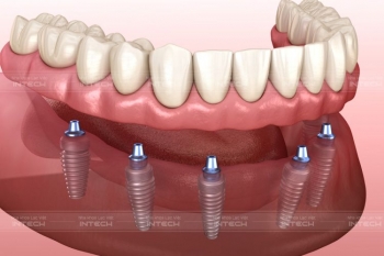 Trồng răng Implant toàn hàm phương pháp All on 4, All on 6