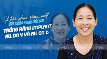 Lấy lại khả năng ăn nhai với phương pháp trồng răng Implant toàn hàm