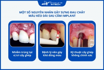 Trồng răng Implant có nguy hiểm không? 4 cách hạn chế biến chứng